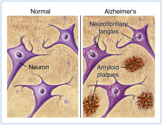 Mảng “beta amyloid” là nguyên nhân cơ bản dẫn đến bệnh Alzheimer