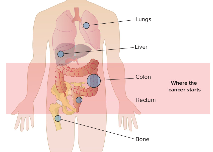 Ung thư dạ dày di căn có thể xuất hiện ở nhiều cơ quan trong cơ thể.