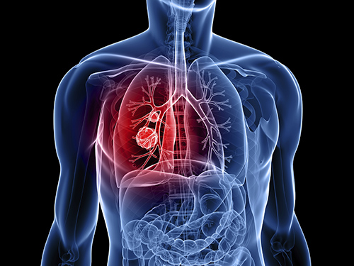 phát hiện khối u ở phổi