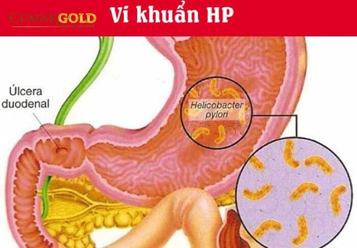 Vi khuẩn HP gây viêm niêm mạc dạ dày hành tá tràng