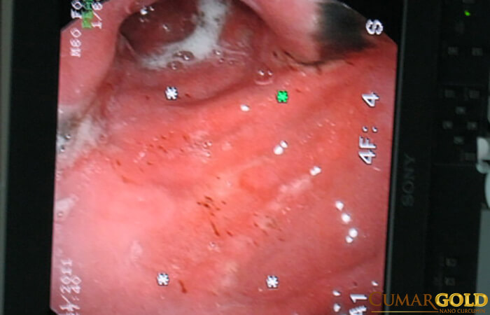 Hình ảnh nội soi của viêm trợt hang vị.