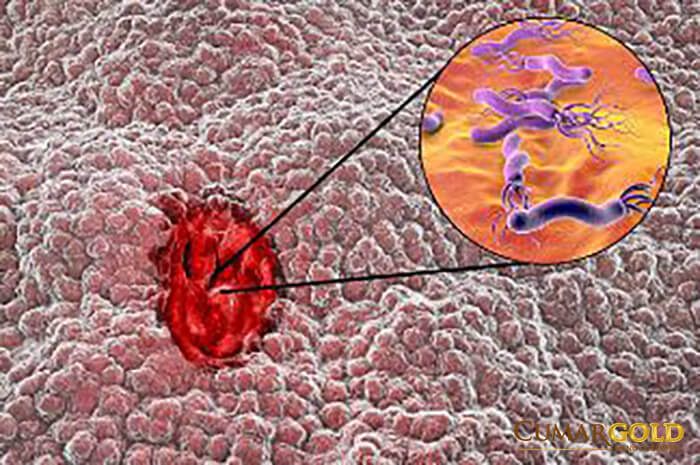 Hình ảnh vi khuẩn HP xâm nhập dưới lớp lót dạ dày