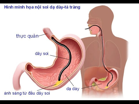 hình ảnh minh hoạt về nội soi dạ dày tá tràng