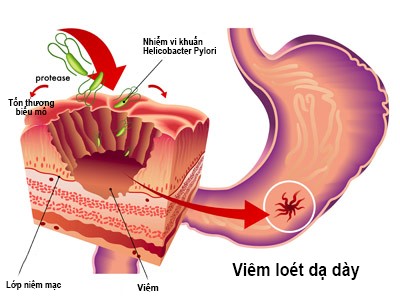 viêm loét dạ dày do nhiễm khuẩn hp