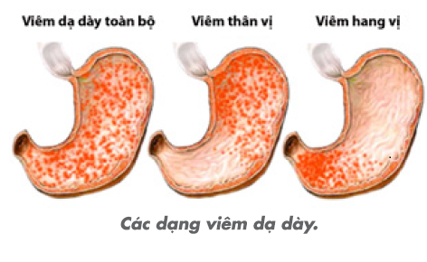 Hình ảnh viêm hang vị dạ dày (hình 3)