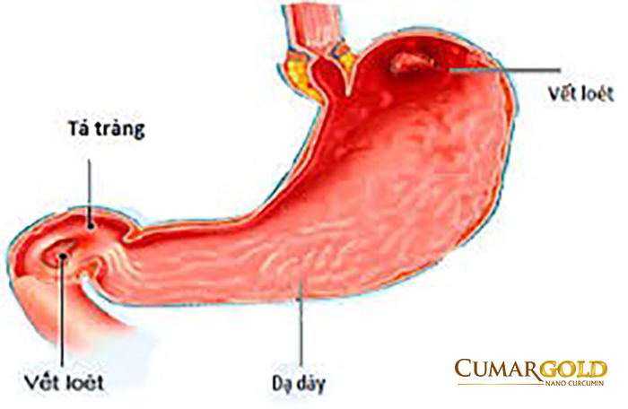 Vị trí hành tá tràng