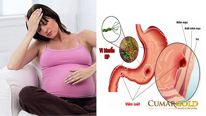 Đau dạ dày khi mang thai do vi khuẩn HP