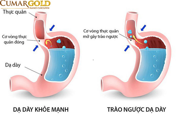 Chứng trào ngược dạ dày thực quản