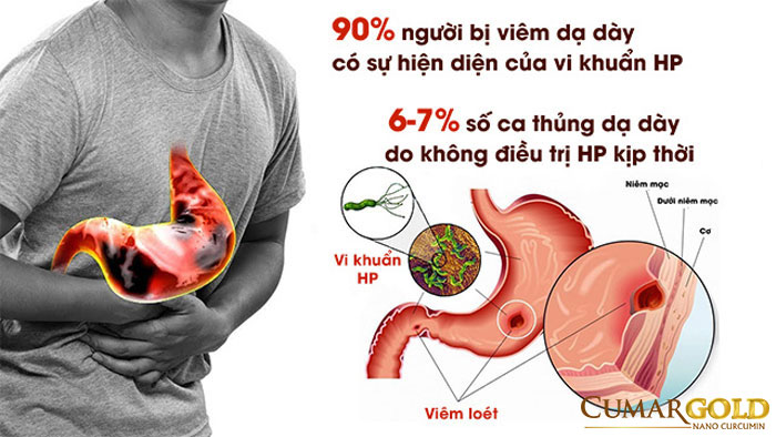 Người bị nhiễm vi khuẩn HP cần kiêng ăn gì để có thể hỗ trợ điều trị vi khuẩn HP
