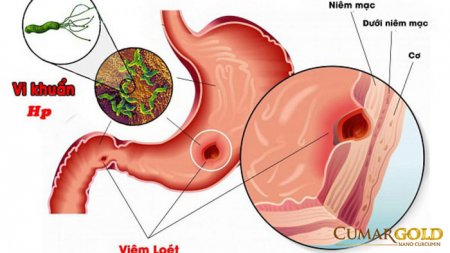 Vi khuẩn HP gây bệnh gì? 5 căn bệnh nguy hiểm do HP gây ra