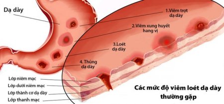 Cùng PGS.TS Nguyễn Thị Bay giải đáp thắc mắc – Viêm loét dạ dày nên dùng gì hiệu quả?