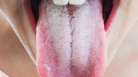 Tại sao trào ngược dạ dày gây viêm lưỡi rát lưỡi, lưỡi trắng?